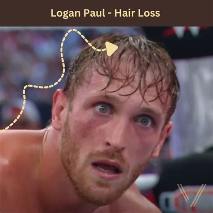 Is Jake Paul Balding? Evidence of His and Logan's Hair Loss |